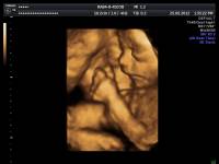 24. týždeň tehotenstva - sono 3D