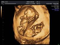 12. týždeň  tehotenstva - dvojičky - sono 3D